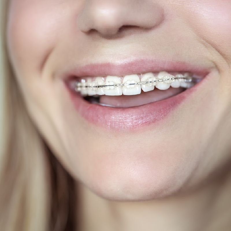 Close-up of a smile with braces