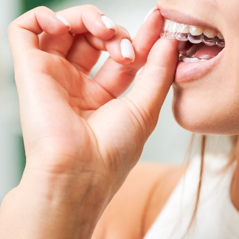 Patient putting in a clear aligner